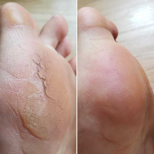 Electric Pedi Callus Remover