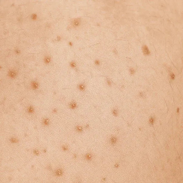 Smoothing Solution Ingrown Hair Treatment