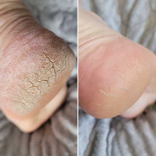 Electric Pedi Callus Remover